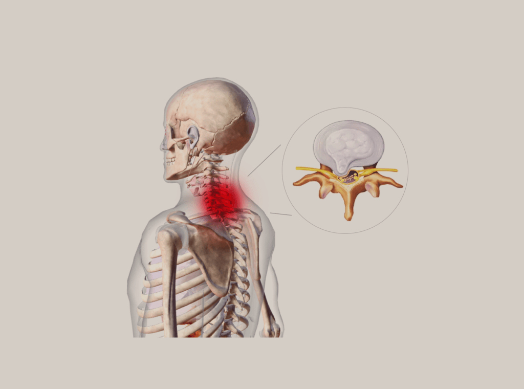 הפרעות שכיחות - בלט דיסק צווארי (cervical bulge disc)