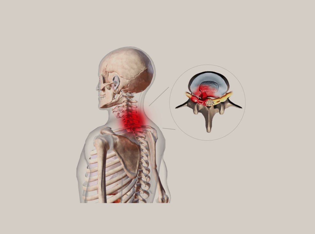 הפרעות שכיחות - פריצת דיסק צווארי (cervical herniated disc)