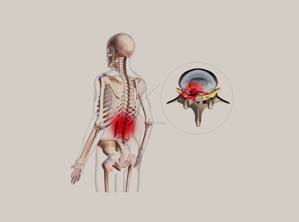 הפרעות שכיחות - פריצת דיסק לומברי (lumber herniated disc)